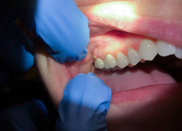 Best Emergency Gum Treatment in Granby, MO